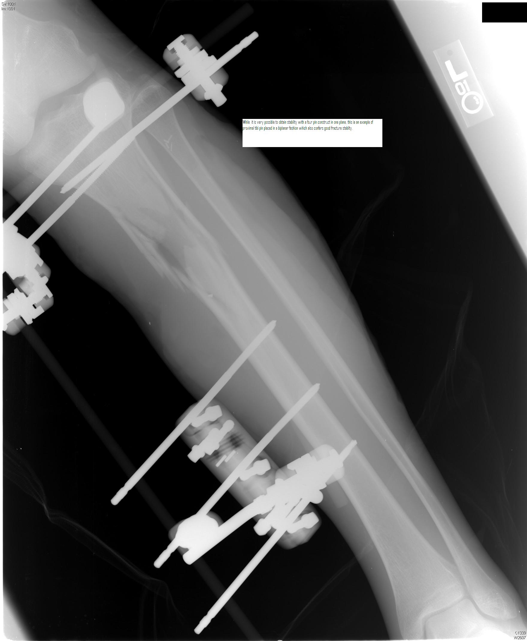 IV. Extremity Fractures in an Austere Environment : Wheeless' Textbook ...