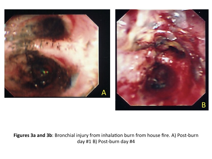 burn patients intubation