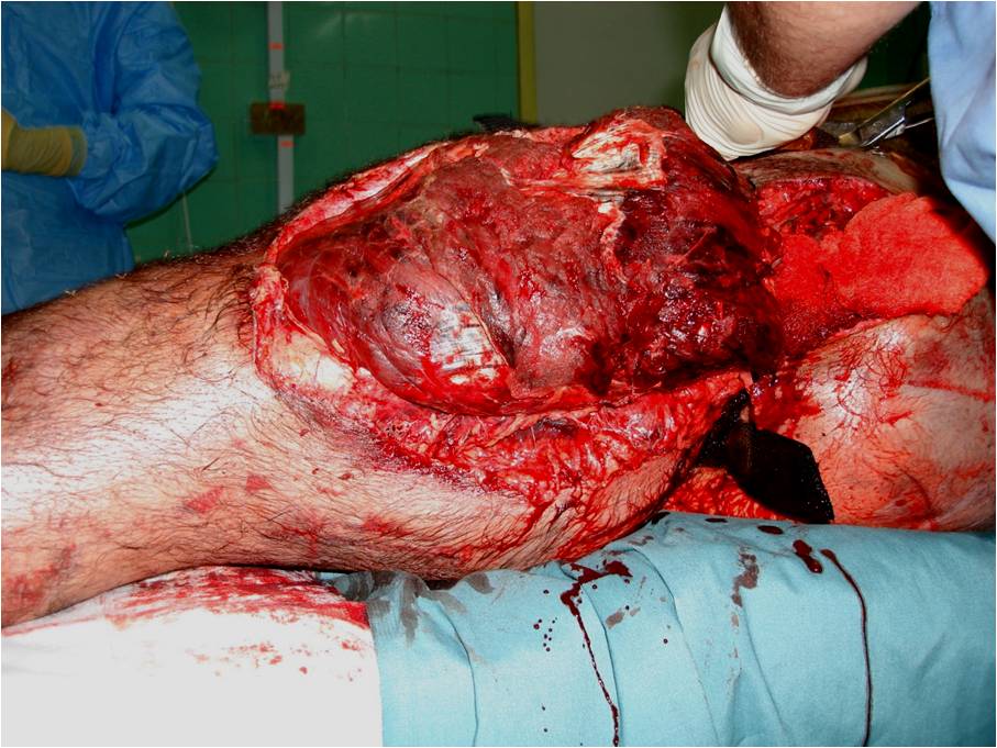 V. Axial Skeleton Injuries in an Austere Environment - I : Wheeless'  Textbook of Orthopaedics