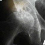 Hip Osteoarthritis 1