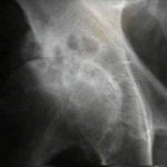 Hip Osteoarthritis 2