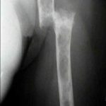 Humerus 12