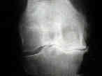 Osteoarthritis of the Knee