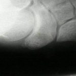 Accessory Navicular 4