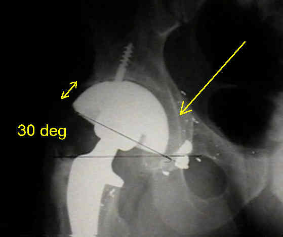 Thr Acetabular Reaming Wheeless Textbook Of Orthopaedics