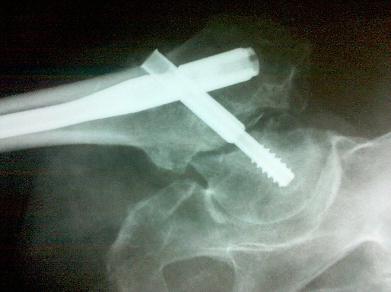 Trochanteric Femur Nail - Griportho