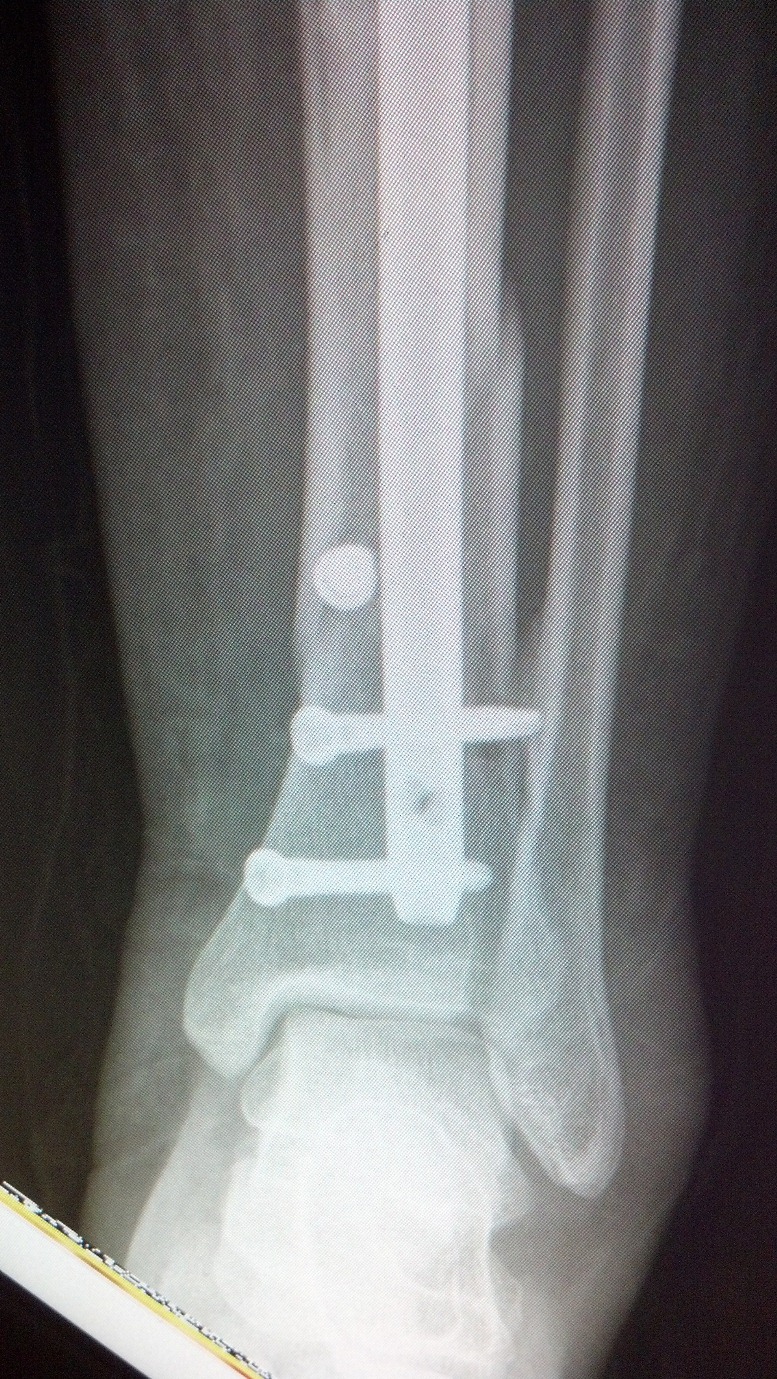 Comparison of free-hand fluoroscopic guidance and electromagnetic  navigation in distal locking of tibia intramedullary nails. - Abstract -  Europe PMC