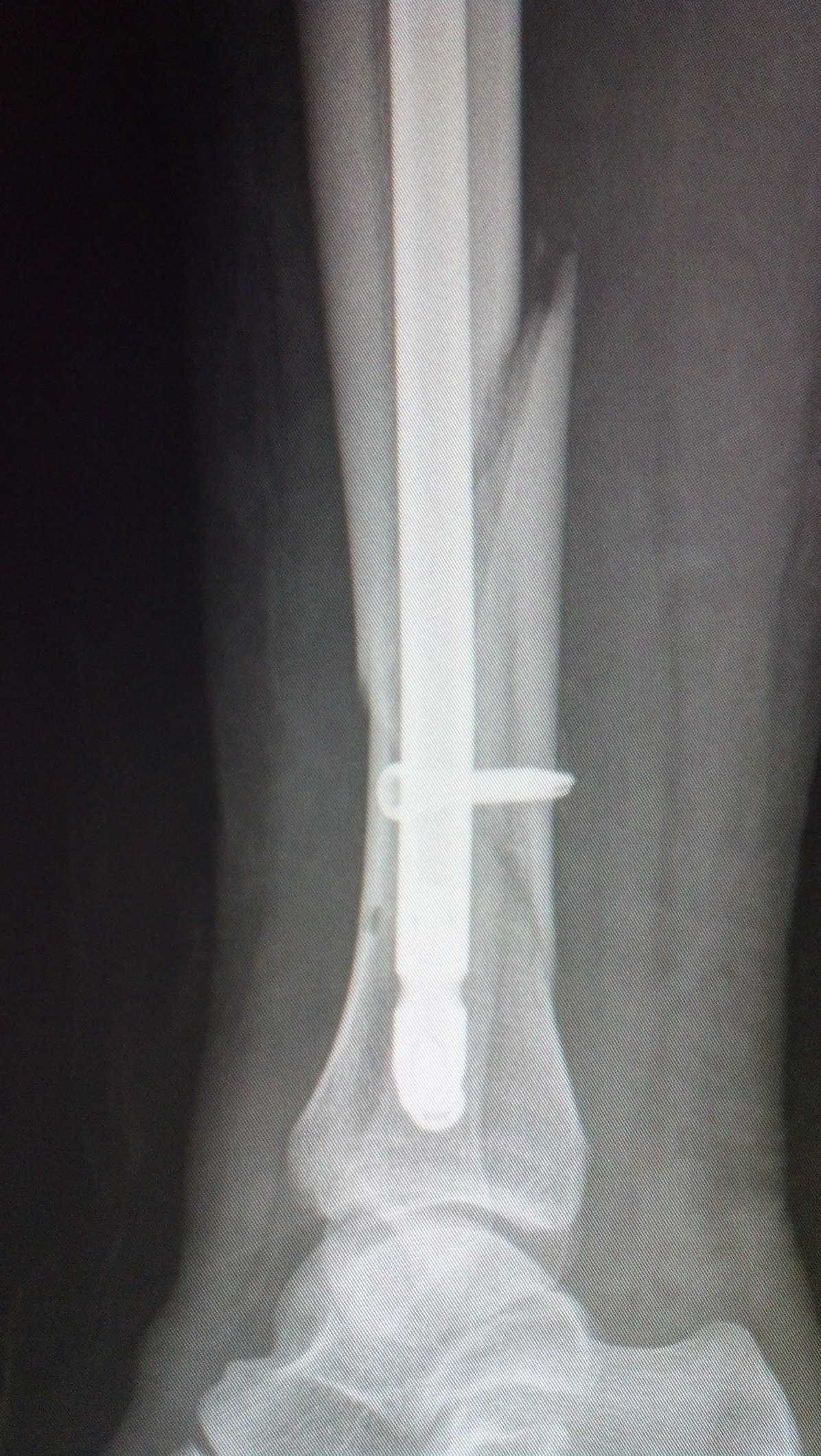 Tibial Fractures: Technique of IM Nailing : Wheeless' Textbook of  Orthopaedics