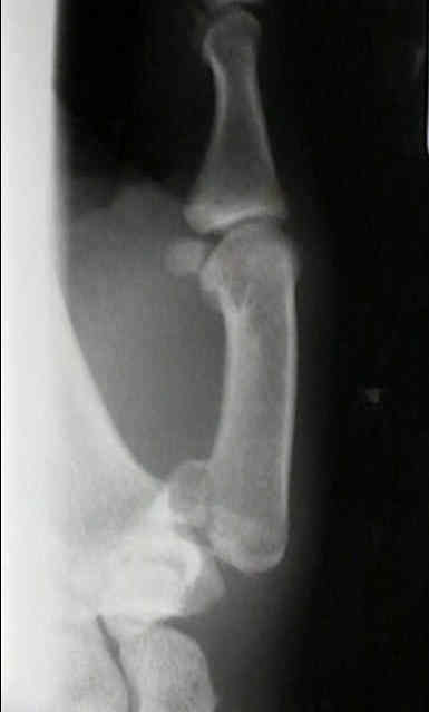 Bennett's Fracture Dislocation : Wheeless' Textbook of Orthopaedics