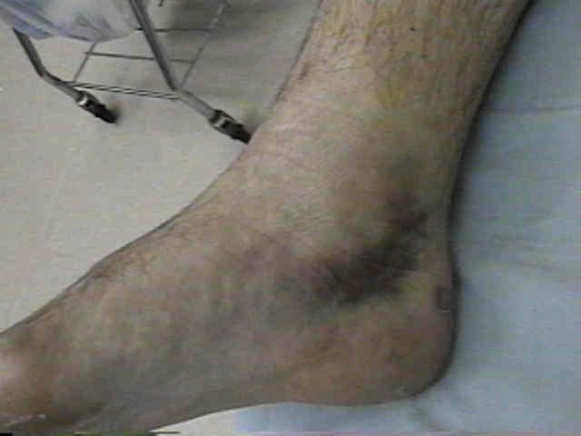 Ankle supination trauma