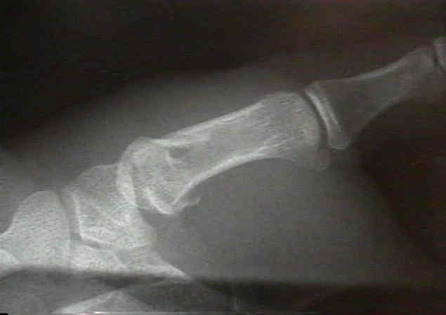 Radiographs For The Thumb Basal Joint Wheeless Textbook Of Orthopaedics Radiographs For The Thumb Basal Joint Wheeless Textbook Of Orthopaedics