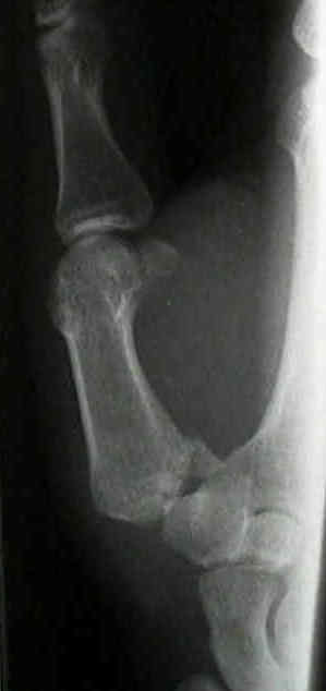 Bennett's Fracture Dislocation : Wheeless' Textbook of Orthopaedics