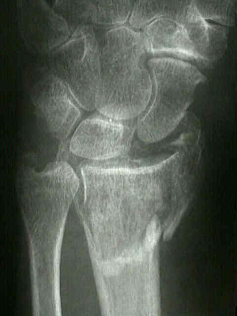 Volar barton fracture