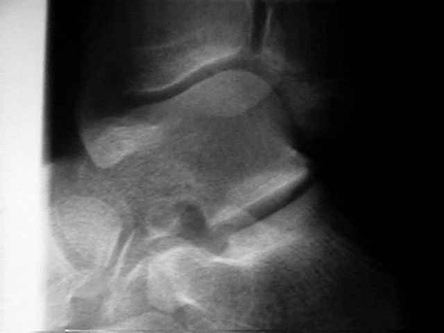 Oblique X-ray shows a calcaneal spur (detailed evalutation on lateral... |  Download Scientific Diagram