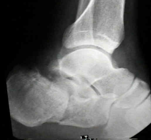 Postoperative radiographs (A, lateral view; B, axial view) and CT... |  Download Scientific Diagram