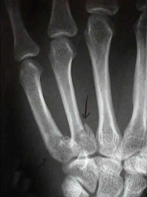 Metacarpal Extra-articular Base Frx : Wheeless' Textbook of Orthopaedics