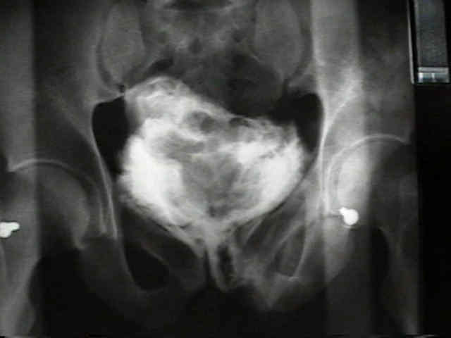 Young and Burgess Classification of Pelvic Ring Injuries [15] Anterior... |  Download Scientific Diagram