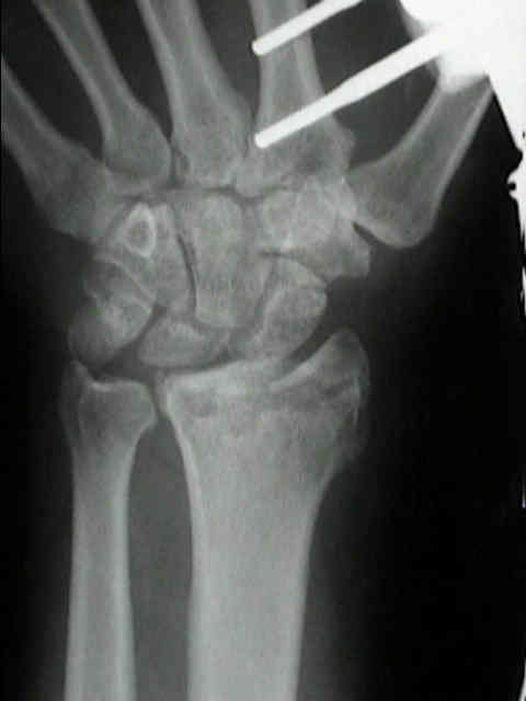 Distal Radius Intramedullary Nail (DRIM-Nail) for the fixation of  extraarticular fractures