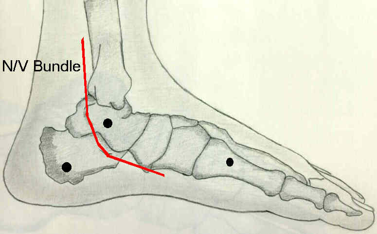 Calcaneal pins : Wheeless' Textbook of Orthopaedics