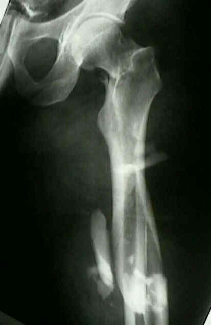 Frx of Ipsilateral Femoral Shaft and Hip : Wheeless' Textbook of Frx of Ipsilateral Femoral Shaft and Hip : Wheeless' Textbook of