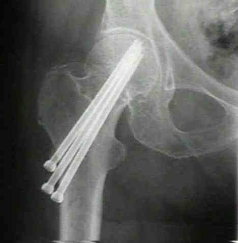 Cannulated Screws for Femoral Neck Fracture : Wheeless' Textbook of