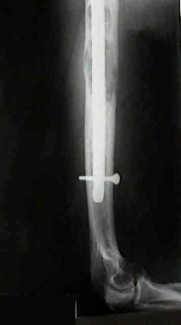 ORIGINAL ARTICLE Fixation of Fractures of the Humerus in Adults Using  Intramedullary Elastic Nails