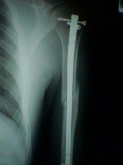 Elastic stable intramedullary nailing as a treatment option for comminuted  proximal humeral shaft fractures in adults: A report of two cases and a  review of the literature - Journal of Musculoskeletal Surgery