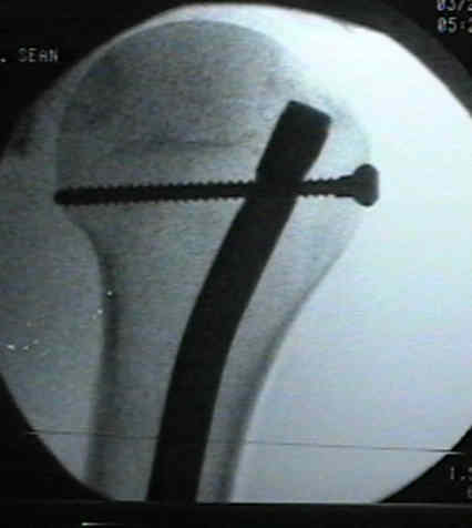 Metatstatic distal humerus fracture - nail with 'poller wires'