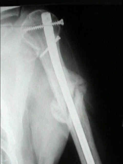 Early outcomes of magnetic intramedullary compression nailing for humeral  fractures | European Journal of Orthopaedic Surgery & Traumatology