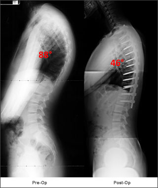 hyperkyphosis