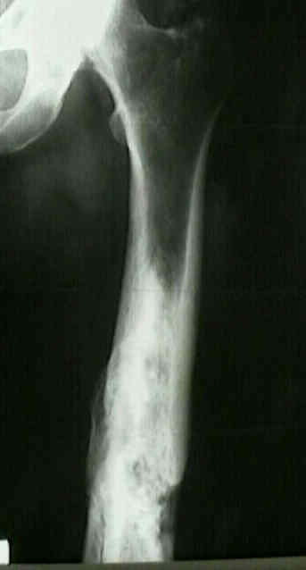 Composition of the traditional and novel intramedullary nail internal... |  Download Scientific Diagram