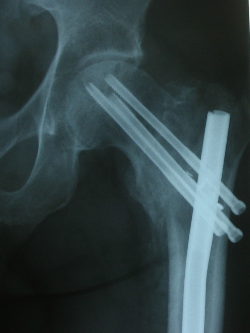 Figure 3 from Treatment of extracapsular hip fractures with the proximal femoral  nail (PFN): long term results in 45 patients. | Semantic Scholar