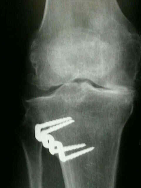 High Tibial Osteotomy Wheeless Textbook Of Orthopaedics