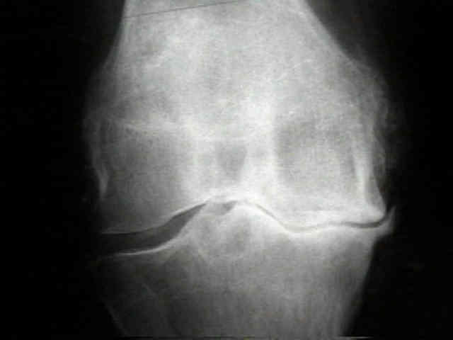 a kezek disztális interphalangealis ízületeinek osteoarthritis