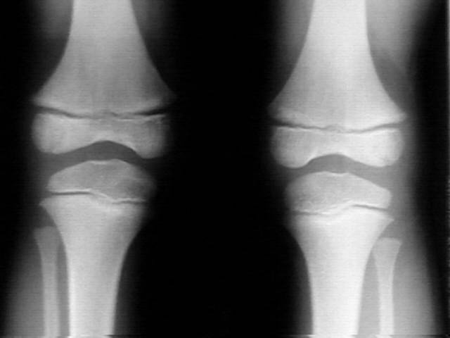 Short stature and hypothyroidism in a child with Nail-Patella Syndrome. A  case report