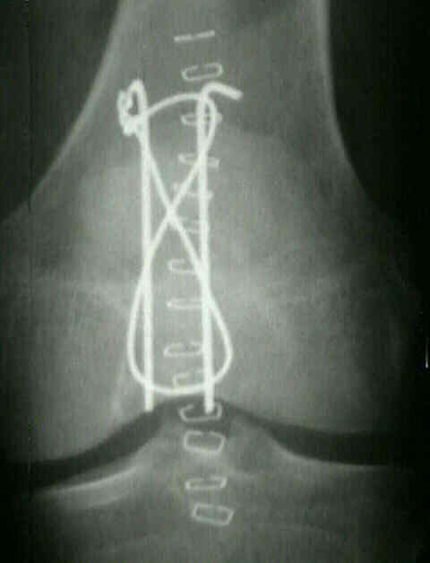 Перелом надколенника операции. Перелом надколенника остеосинтез. Остеосинтез надколенника проволокой. Остеосинтез надколенника по Веберу. Остеосинтез надколенника по Веберу рентген.