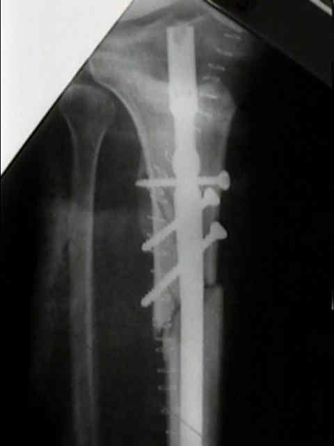 Distal locking of a tibial nail in the presence of a distal tibial plate