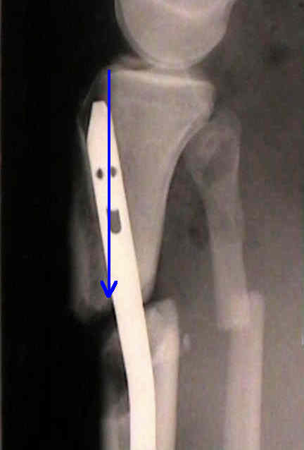 Figure 1 from Extending the indications of intramedullary nailing with the  Expert Tibial Nail. | Semantic Scholar