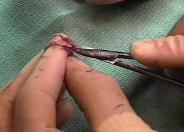 Full Thickness Skin Grafts : Wheeless' Textbook of Orthopaedics