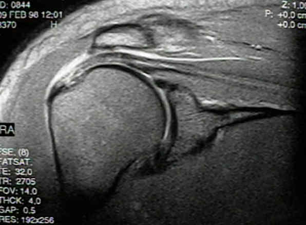 Rotator Cuff Tears : Wheeless' Textbook of Orthopaedics