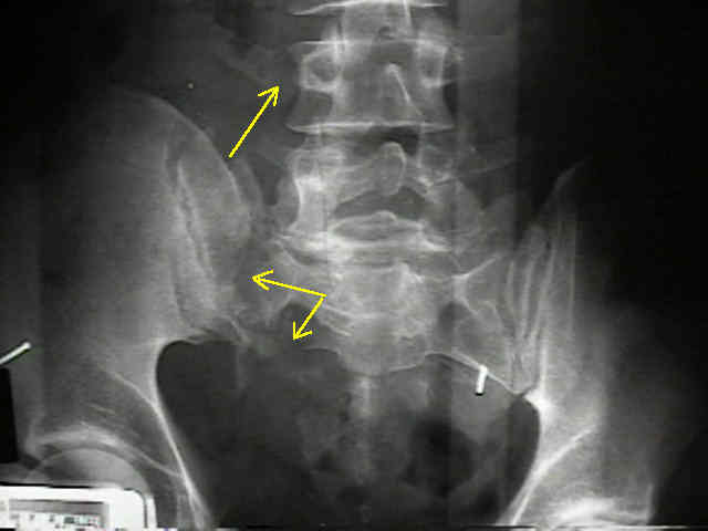 Sacrum and Sacral Fractures : Wheeless' Textbook of Orthopaedics