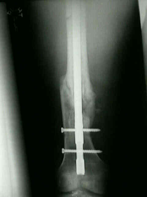 Augmentative locking plate with autologous bone grafting for distal femoral  nonunion subsequent to failed retrograde intramedullary nailing - Ru et al.  2016a - Scipedia