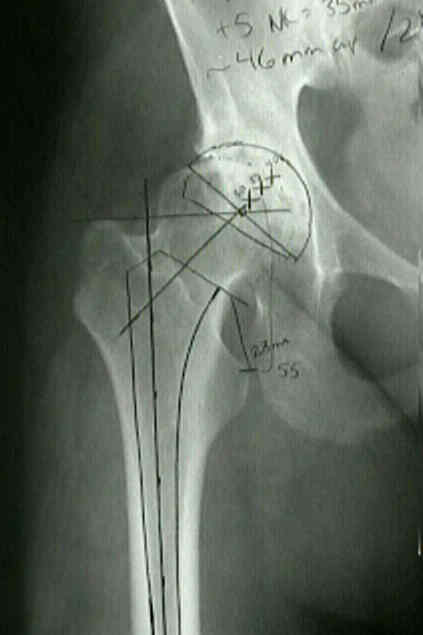 Preop Acetabular Radiographic Evaluation Wheeless Textbook Of