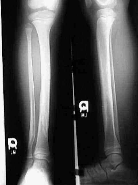 Broken Leg: If my tibial shaft fracture gets surgery, when can I