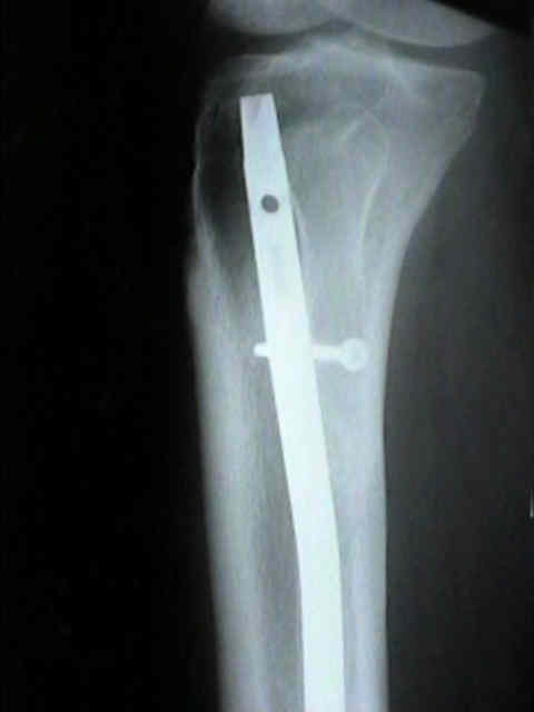 Shortening and re-lengthening versus bone transport for the treatment of  distal tibial periarticular post-traumatic defects | Scientific Reports