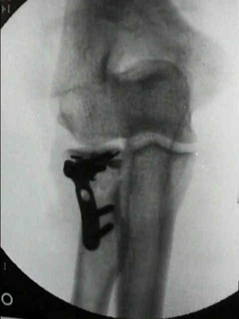 Essex Lopresti Fracture : Wheeless' Textbook of Orthopaedics