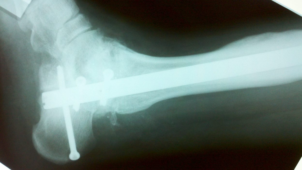 The King s Sliding Hindfoot Osteotomy for the Treatment of Talus Body  Defects—Results of a New Technique in Tibiotalocalcaneal